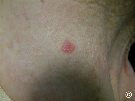 Basal Cell Carcinoma Early Stages Face