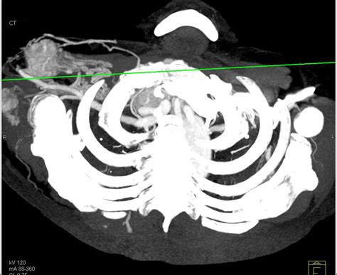 Vascular Muscle Metastases From Renal Cell Carcinoma Chest Case