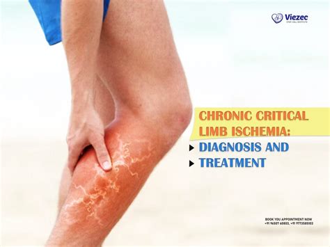 Chronic Critical Limb Ischemia Diagnosis And Treatment