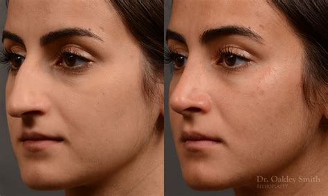 422d Rhinoplasty Dr Oakley Smith Toronto Top Surgeon Nose Job