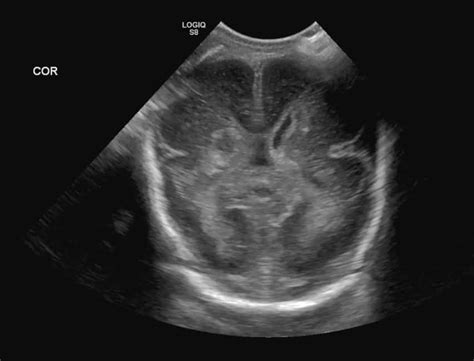 Cranial Ultrasound Uams Department Of Radiology