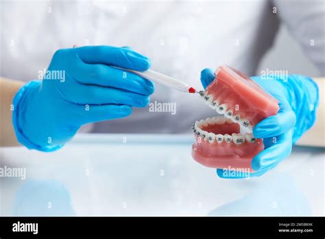 Doctor Orthodontist Showing Model Of Human Jaw With Wire Braces