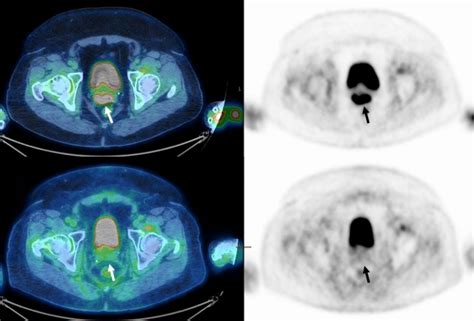 Sixty Two Year Old Woman With Figo Stage Iib Cervical Cancer Squamous Download Scientific