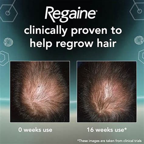 Regaine For Men Extra Strength Scalp Foam 5 W W Foam 3pk Healthwise