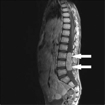 MRI Of The Spine Sagittal Contrast Enhanced T1 Weighted Image Shows A