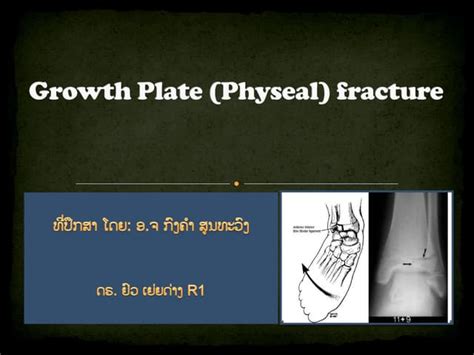 Growth Plate Physeal Fracture Ppt