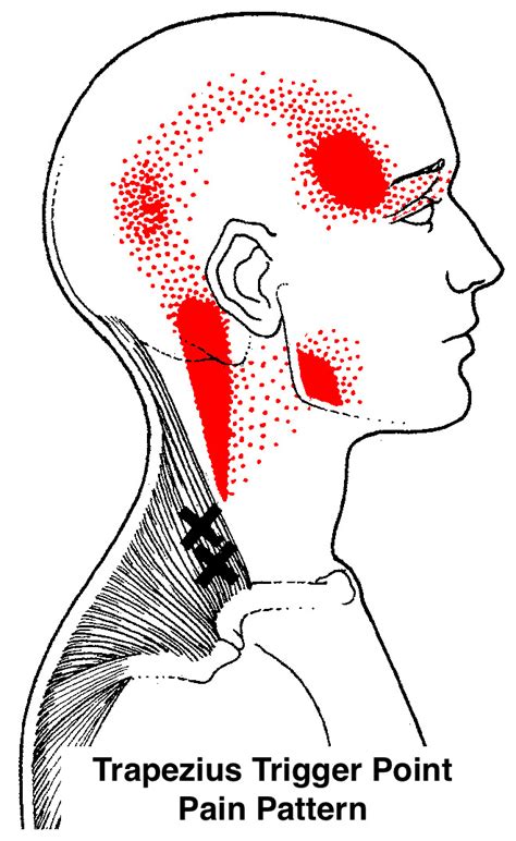 Jaw Pain Explained — Bristol Massage Clinic