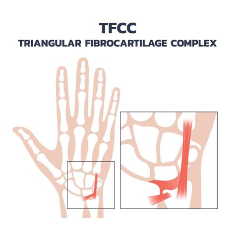 Tfcc Tears Treatment Sydney Orthopaedic Surgeon