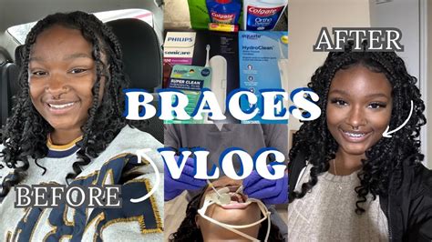 Braces Vlog Come With Me To Get My Braces First Hrs With Braces