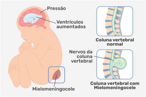 Mielomeningocele: definición, síntomas, causas y tratamiento - Tua Saúde