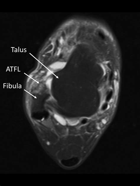 Ankle Instability — Daniel Bohl, MD | Midwest Orthopaedics at RUSH