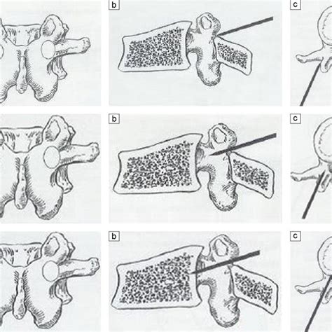 X Ray Films Of True Ap View Percutaneous Pedicle Screw Insertion Download Scientific Diagram