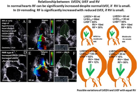 Echocardiographic Assessment Of Functional Mitral Regurgitation