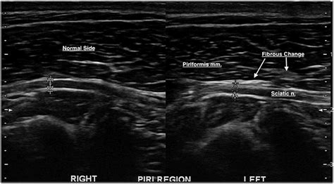 Piriformis Syndrome Ultrasound