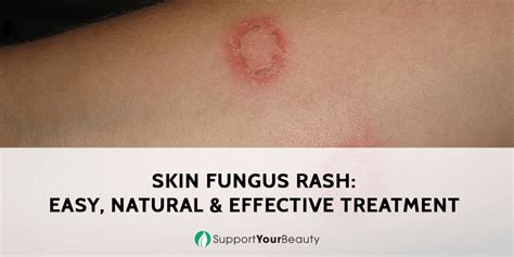 Fungal Skin Rash