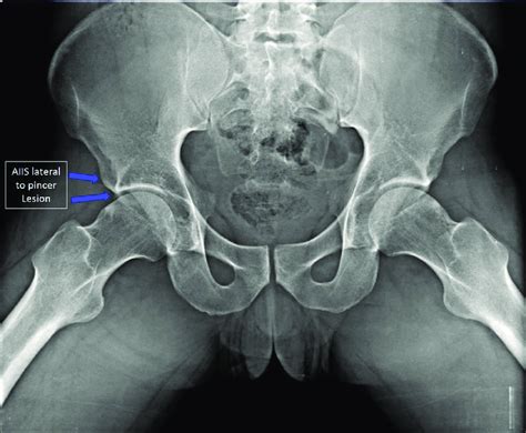 Anteroposterior Pelvic Radiograph Demonstrating Excessive Pelvic Tilt