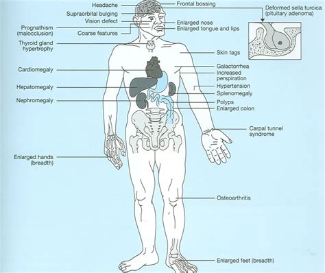 Acromegaly:Definition,Causes,Symptoms,Diagnosis,Treatment