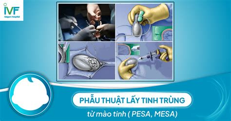 Ph U Thu T L Y Tinh Tr Ng T M O Tinh Pesa Mesa