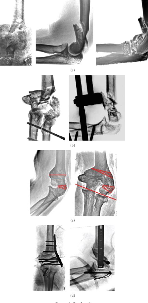 Figure 1 From Intra Articular Osteotomy For Distal Humerus Malunion