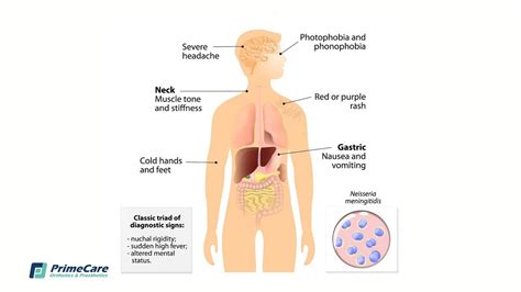 Meningitis: Causes, Symptoms, Amputation | PrimeCare Orthotics ...