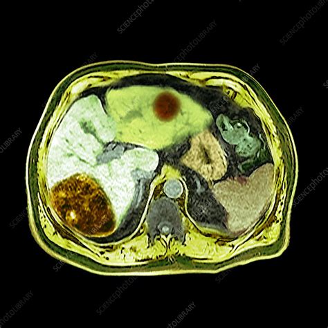 Liver Cancer Ct Scan Stock Image F0281839 Science Photo Library