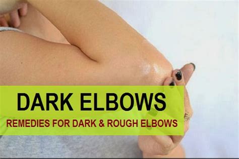 Home Remedies to Lighten Rough Dark Elbows