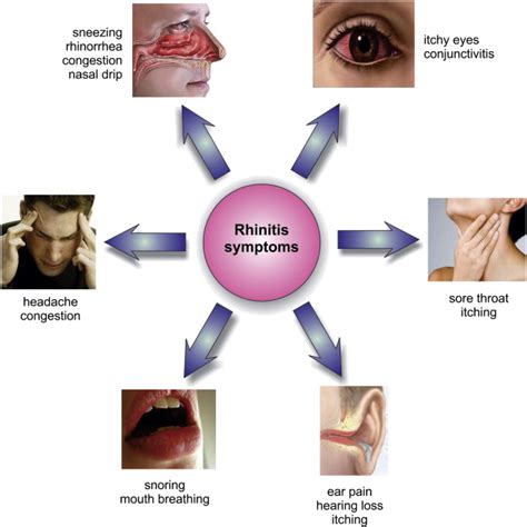 What Causes Allergic Rhinitis Learn The Symptoms And Treatment