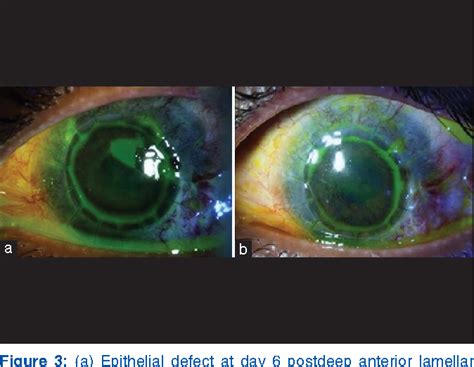 Figure 1 From Outcomes Of Deep Anterior Lamellar Keratoplasty Following Autologous Simple Limbal