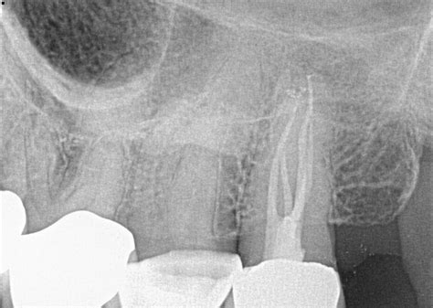 Minimally Invasive Endodontics With Laser Activated Irrigation