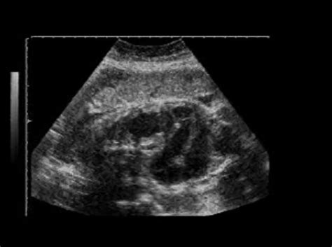 Ileal Atresia Ultrasoundpaedia