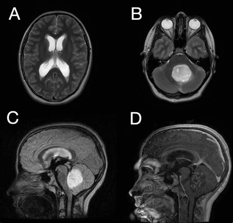 Preoperative Mri Scan A Axial Section T Weighted Image Showing