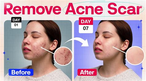 How To Get Rid Of Acne Scars How To Remove Acne Scars Remove Acne