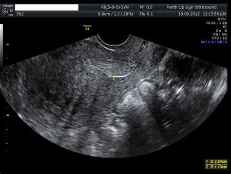 Pelvic Ultrasound - POGU