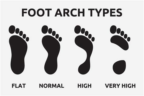 High Arches Causes Symptoms And Treatment Sanders Podiatry