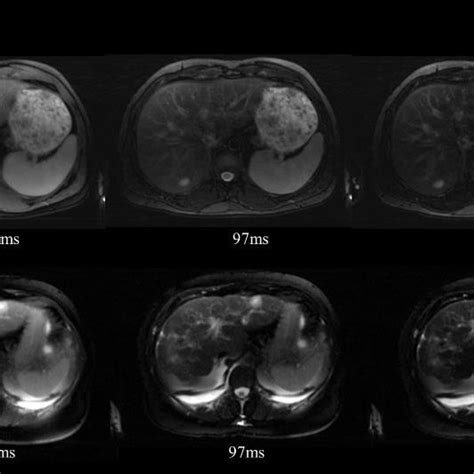 Representative T2w Images 3 Out Of 32 Tes And T2 Maps Of The Abdomen