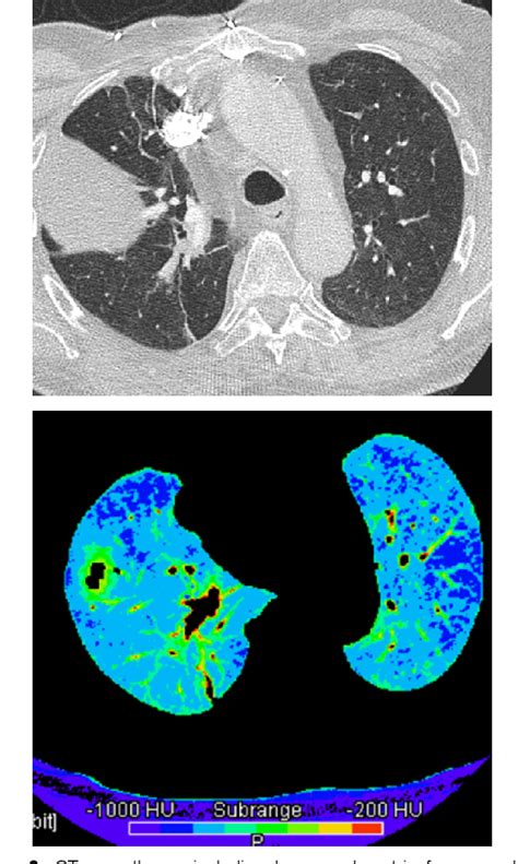 Figure 3 From Treatment Associated Interstitial Pulmonary Toxicity Of