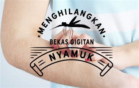 Cara Menghilangkan Bekas Gigitan Nyamuk Yang Alami Dan Efektif