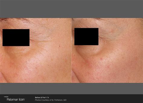 1540 Laser Skin Rejuvenation Newport Medical And Wellness Center