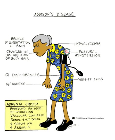 ALL FOR NURSING MS Addison S Disease Vs Cushing S Disease