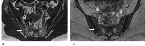 Figure From Sacroiliitis Findings On Conventional Radiography Ct