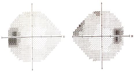 Humphrey Visual Field Testing 24 2 Shows Enlarged Blind Spots In Both