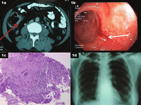 A Contrast Enhanced Computed Tomography Of The Abdomen Showing