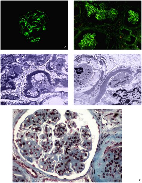 A B C Ddd With Mesangial And Capillary Staining For C In