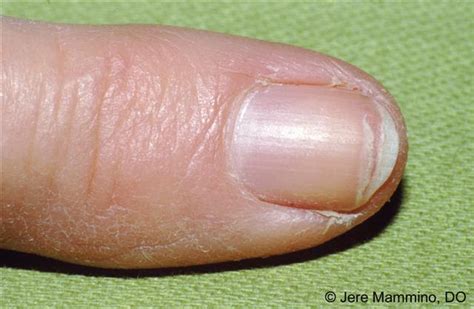 Lines On Nails Vitamin Deficiency Awesome Nail