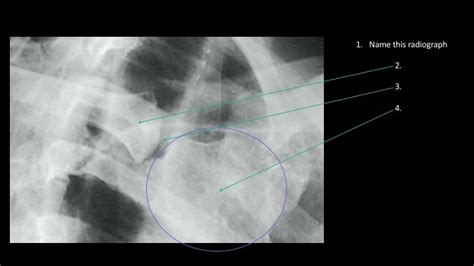 DIAGRAM - Oblique SC Joint(RAO) Anatomy(Xray) - 2018 Diagram | Quizlet