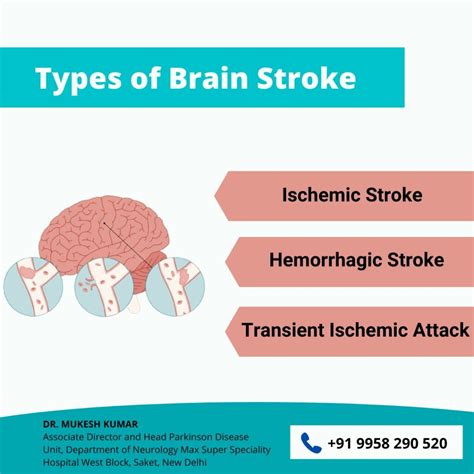 Stroke Specialist Doctor In Delhi Brain Stroke Specialist In Delhi