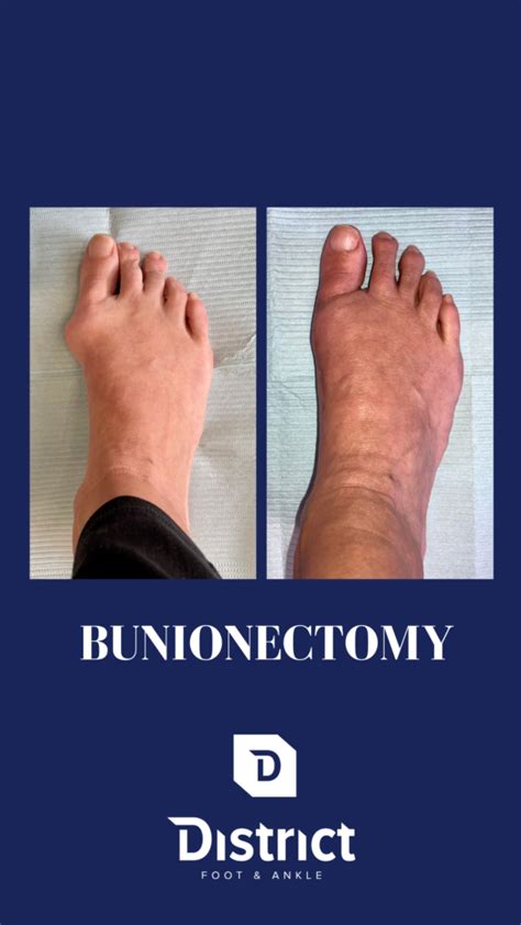 Foot Bunion Treatment Surgery Doctor Alexandria Northern VA