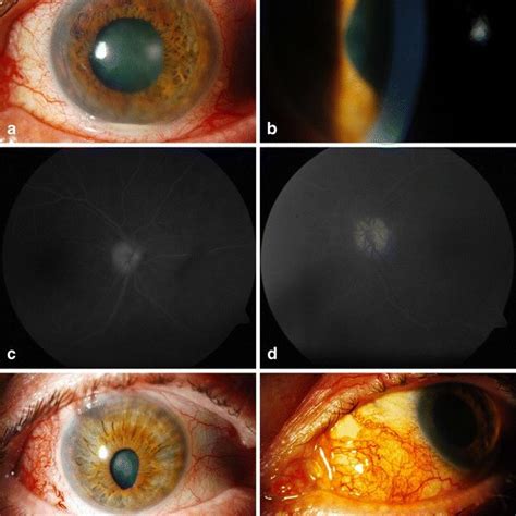 Slit Lamp Photograph Demonstrating Anterior Uveitis With Hypopyon In