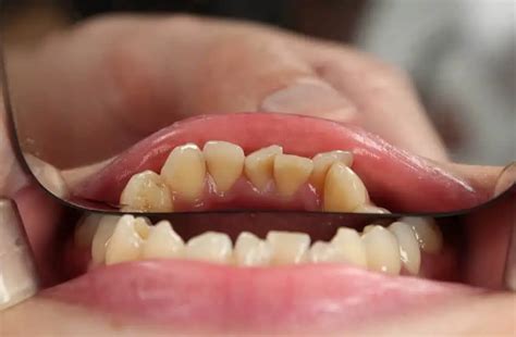 Todo A Saber Sobre La Erosión Dental Clínica Dental En Torremolinos