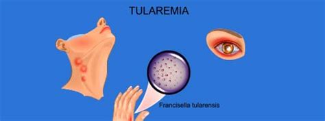 Tularemia The Causes Symptoms And Treatment Of This Dangerous